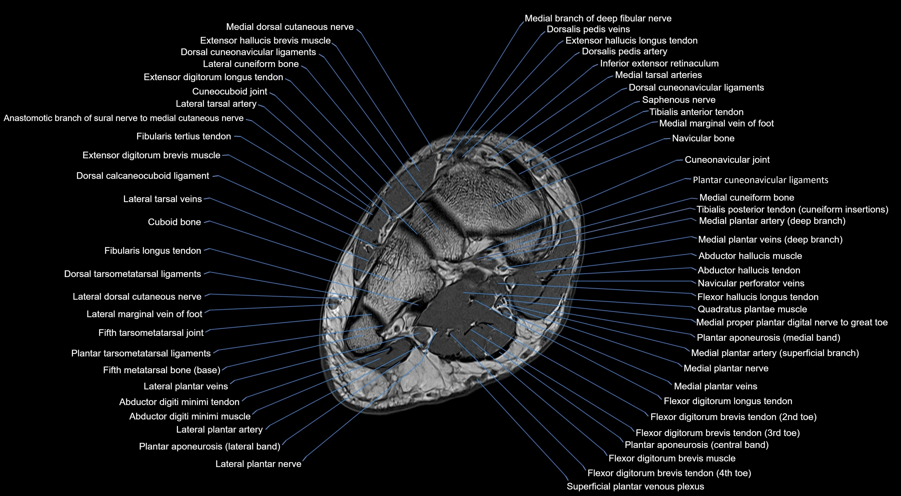 MRI mid foot coronal ligaments cross sectional anatomy 3T  radiology  image-img-00001-00026.webp